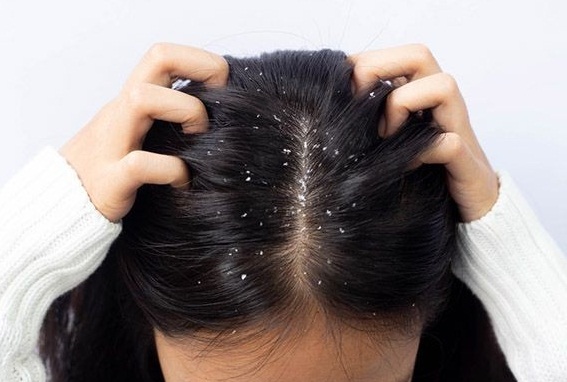 4 Rekomendasi Shampo Buat Atasi Ketombe pada Rambut, Bikin Kulit Kepala Tetap Sehat