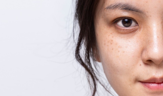 7 Tips Menghilangkan Flek Hitam Membandel di Wajah Secara Alami, Dijamin Ampuh