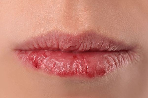 Bye Bye Bibir Pecah Pecah! 7 Tips Mengatasi Bibir Kering Saat Puasa Ramadhan, Terapkan Yuk! 