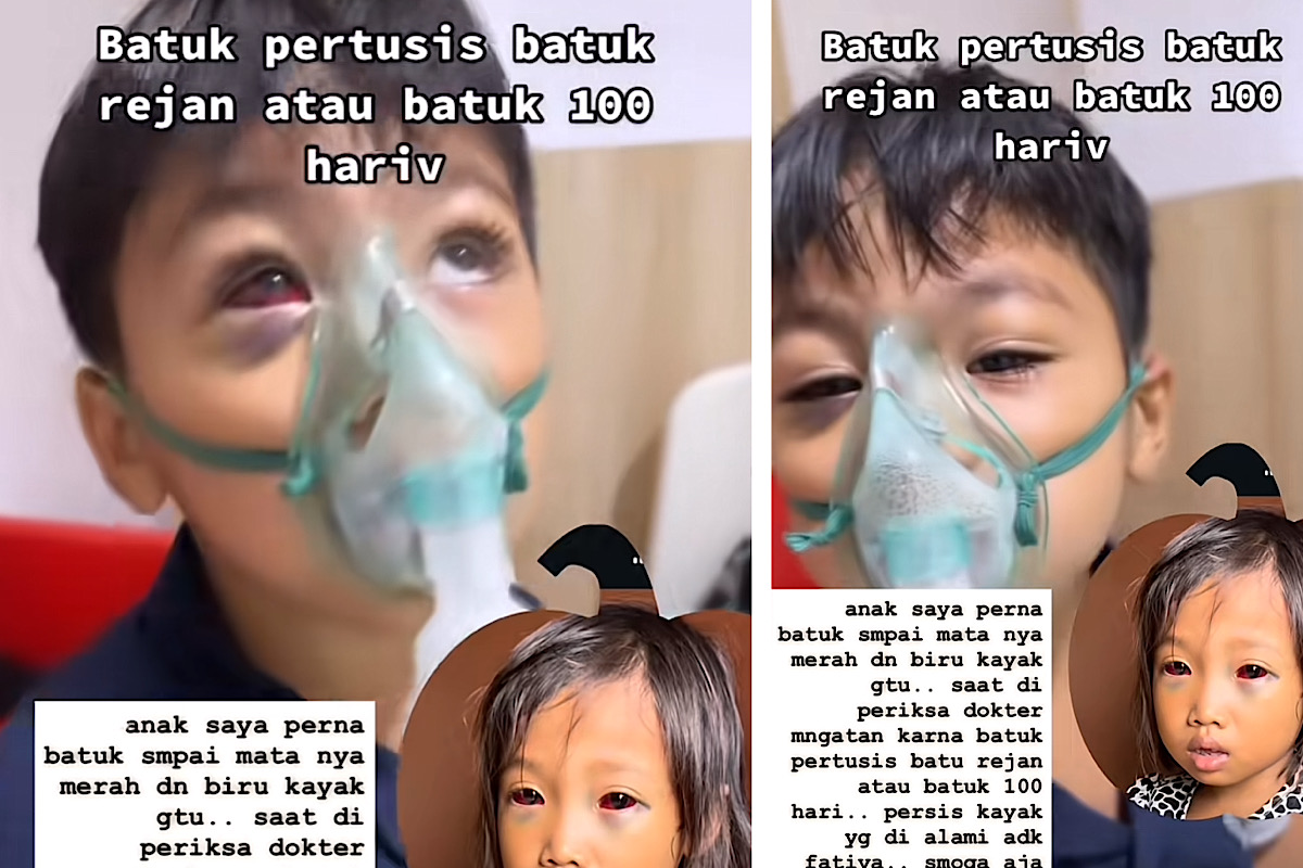 Bocah di Riau Mirip Kasus Mata Merah Fatiyah di Palembang, Netizen: Suudzon Mana Nih Yang Sudah Nuduh Guru!