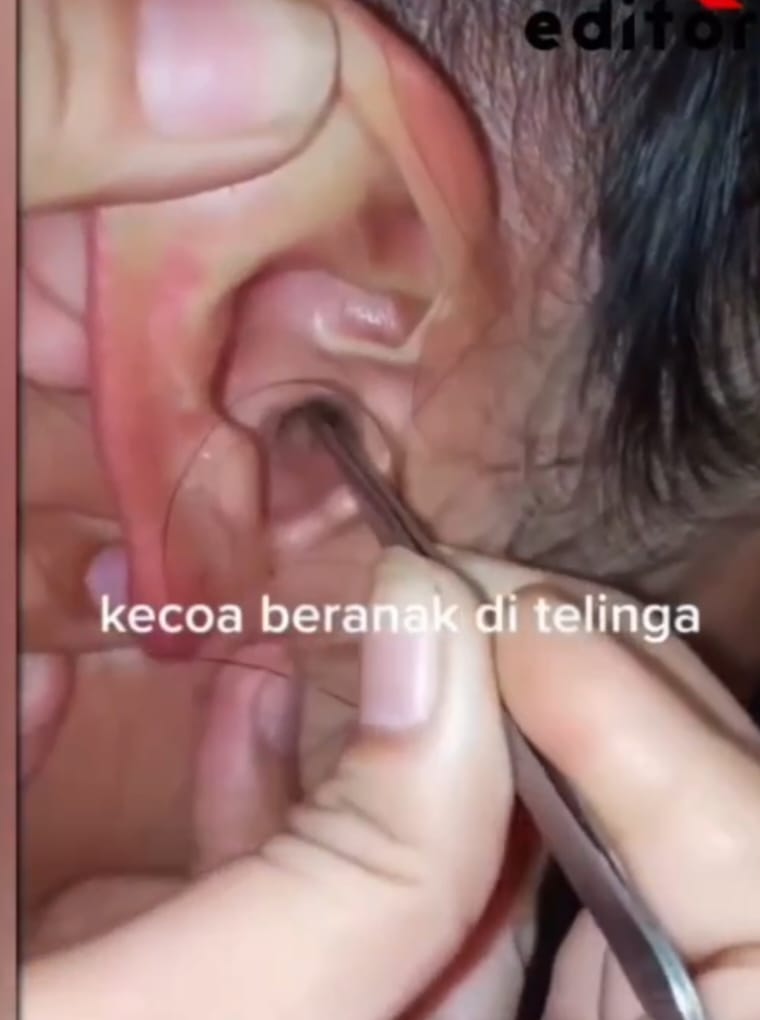 Iuwh...Bikin Merinding Sekaligus Geli, Kecoa Beranak Didalam Telinga Seorang Perempuan, Kok Bisa Ya?