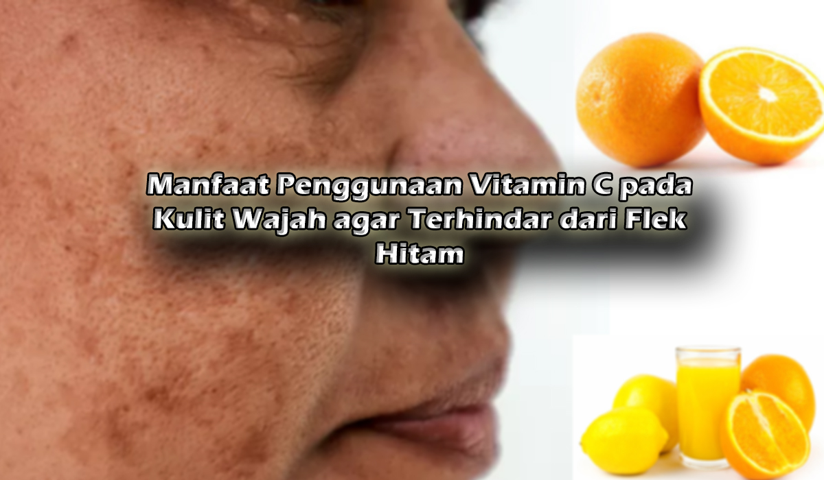 Manfaat Penggunaan Vitamin C pada Kulit Wajah agar Terhindar dari Flek Hitam