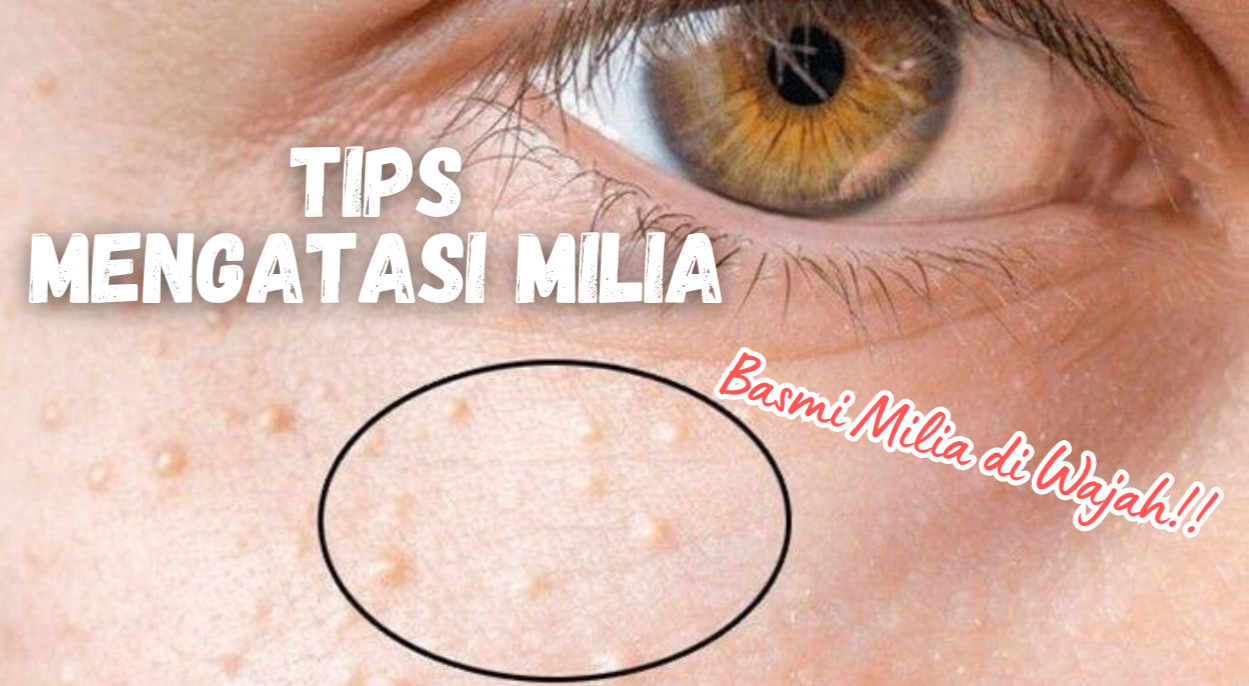 Catat! 5 Tips Mengatasi Milia di Wajah,  Ampuh Bikin Kulit Mulus Lagi