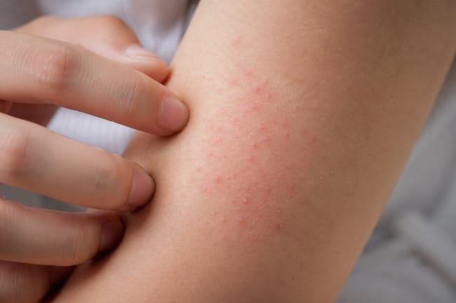 Cara Mengatasi Gatal di Badan, Kenali Penyebab dan Langkah yang Bisa Dilakukan