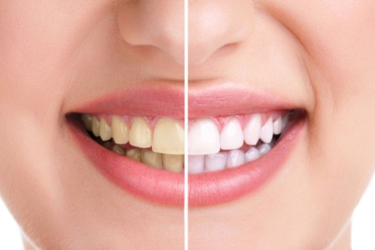 Cuma Pakai Tiga Bahan Ini, Plak Gigi Dijamin Hilang Bersih Seperti Scaling