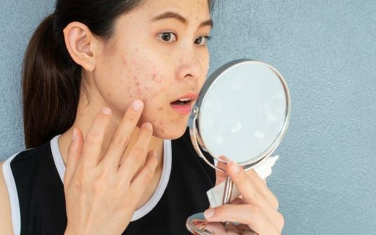 Bye Jerawat! Ini Tips Perawatan Alami dan Medis yang Bikin Kulit Mulus Tanpa Drama