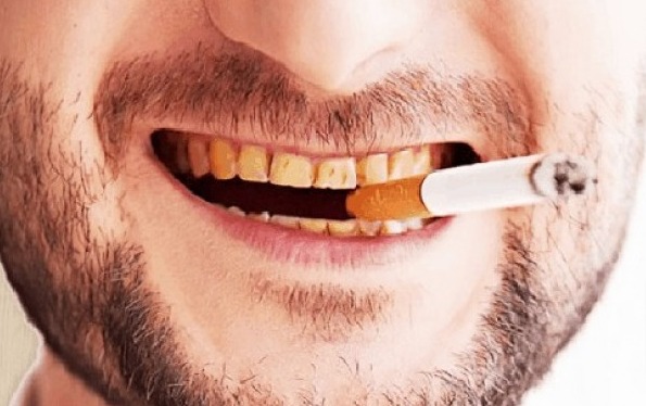 Wow! Ternyata Asap Rokok Bikin Senyum Pria Menyeramkan, Jangan Dibiarkan Bisa Manakutkan