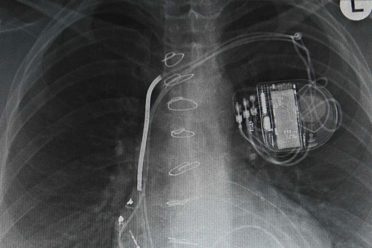 Mesin Jam Tangan Mekanis Menjadi Alat Pacu Jantung Sejak Tahun 1950, Kok Bisa?
