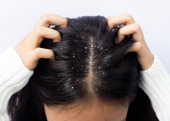 4 Rekomendasi Shampo Buat Atasi Ketombe pada Rambut, Bikin Kulit Kepala Tetap Sehat