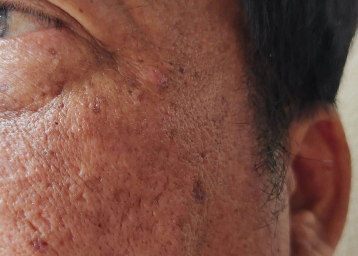 Cara Menghilangkan Flek Hitam di Wajah Secara Alami Menggunakan Lidah Buaya dan Madu