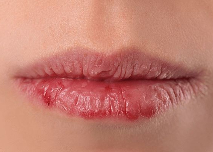 Bye Bye Bibir Pecah Pecah! 7 Tips Mengatasi Bibir Kering Saat Puasa Ramadhan, Terapkan Yuk! 