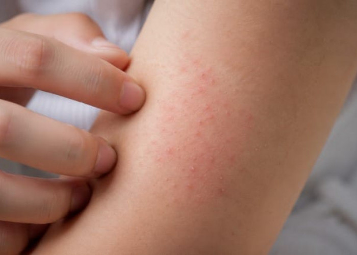 Cara Mengatasi Gatal di Badan, Kenali Penyebab dan Langkah yang Bisa Dilakukan