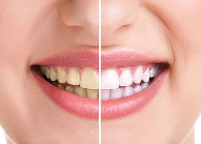 Cuma Pakai Tiga Bahan Ini, Plak Gigi Dijamin Hilang Bersih Seperti Scaling
