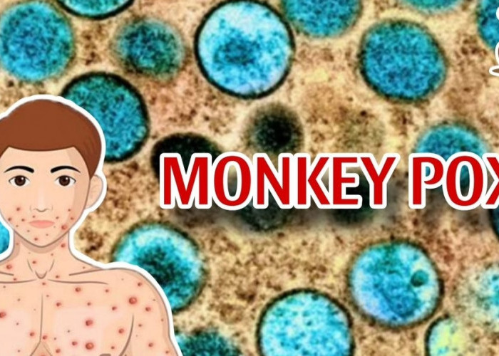 Monkey Pox Kian Menyebar, Pahami Cara Pencegahan Virusnya, Ini Langkah yang Harus Dilakukan