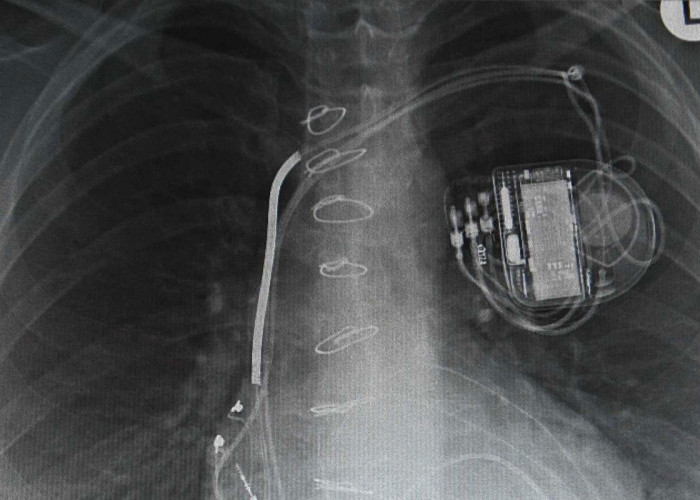 Mesin Jam Tangan Mekanis Menjadi Alat Pacu Jantung Sejak Tahun 1950, Kok Bisa?