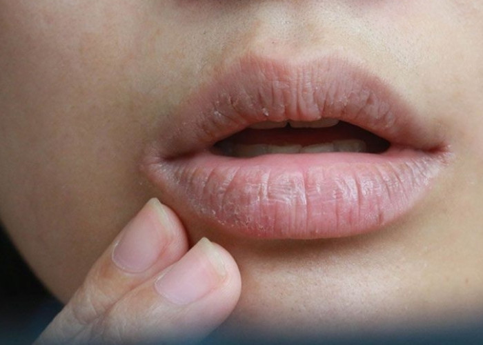 Solusi Efektif Buat Mengatasi Bibir Kering Saat Berpuasa, Nomor 5 Harus Dihindari