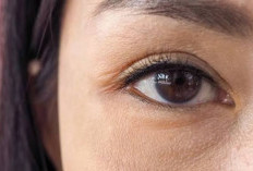 Rahasia Alami Hilangkan Kerutan di Bawah Mata Tanpa Botox, Simak 7 Cara Mudah Ini