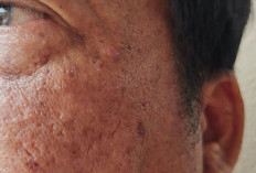 Cara Menghilangkan Flek Hitam di Wajah Secara Alami Menggunakan Lidah Buaya dan Madu