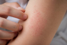 Cara Mengatasi Gatal di Badan, Kenali Penyebab dan Langkah yang Bisa Dilakukan